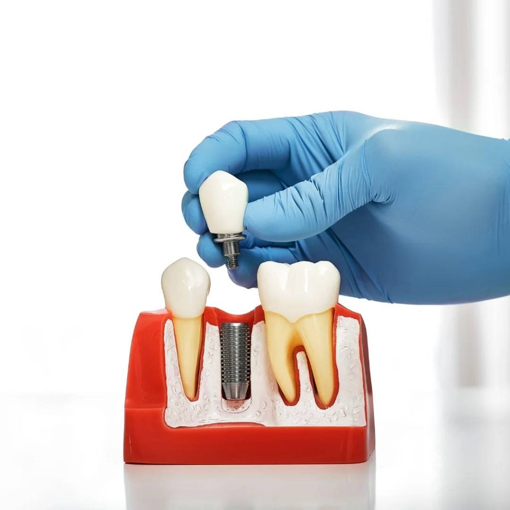 Implant Dentistry in Milverton, ON