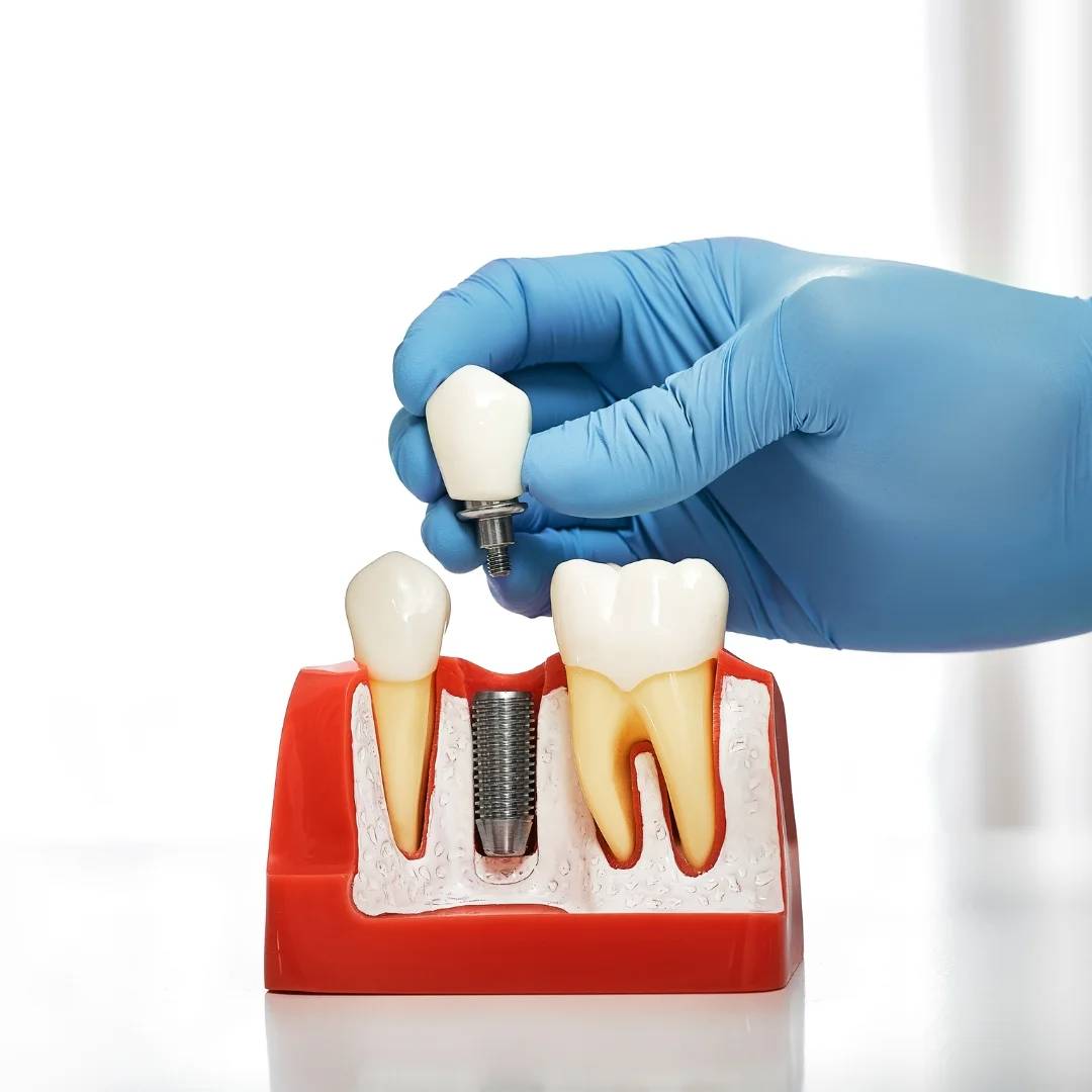 Implant Dentistry in Milverton, ON